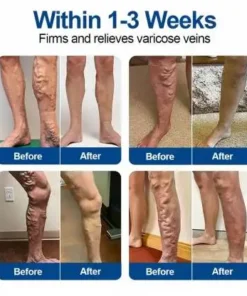 Owiwell® VeinEase Microneedle Care Patch